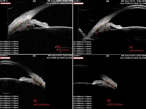 ubm scleral thickness measurement|ubm interpretation.